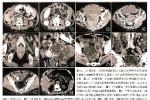 原發性腹膜炎 K65.905 自發性腹膜炎 特發性細菌性腹膜炎