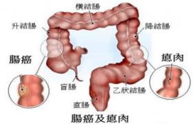 大腸類癌 銀細胞瘤