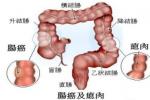 大腸類癌 銀細胞瘤