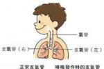 過敏性哮喘 J45.001 