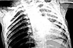 阻塞性肺氣腫 J43.905 慢阻肺 慢性阻塞性肺氣腫 COPD 肺脹