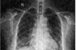 特發性肺纖維化 特發性肺纖維變性 IPF