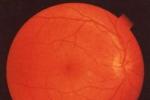 視網膜動脈栓塞 中央視網膜動脈阻塞 眼中風 視網膜動脈阻斷