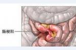 腸梗阻 K56.702 