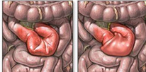 腸套疊 K56.101 