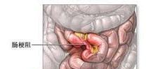 粘連性腸梗阻