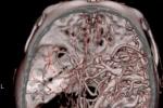 腦動靜脈畸形 Q28.251 腦血管瘤 腦動靜脈瘤 腦血管錯構瘤