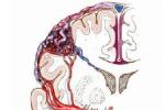 腦動靜脈畸形 Q28.251 腦血管瘤 腦動靜脈瘤 腦血管錯構瘤