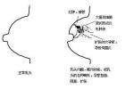 乳腺結核 A18.802 