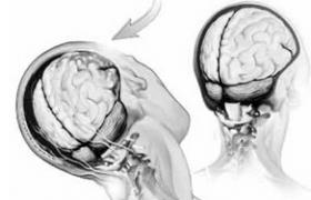 閉合性腦外傷 閉合性腦損傷