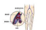原發性下肢深靜脈瓣膜關閉不全 原發性下肢靜脈機能不全