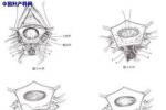子宮切除術後會陰疝 子宮切除後盆底疝