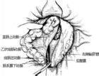 子宮切除術後會陰疝 子宮切除後盆底疝
