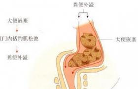 大便失禁 R15.X01 肛門失禁