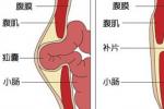 切口疝