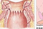 肛門閉鎖 肛門閉合 低位肛門直腸閉鎖