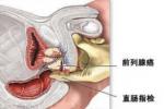 肛門失禁 大便失禁