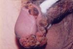 肛周鱗狀細胞癌