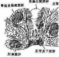 坐骨直腸窩膿腫 K61.352 