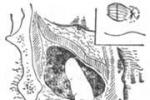 坐骨直腸窩膿腫 K61.352 