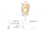 肛管內括約肌痙攣性收縮 肛管內括約肌 痙攣性斜頸 肛管內括約肌失弛