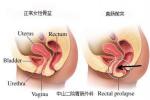 直腸膨出 陰道後壁膨出 直腸前壁突出 直腸前突