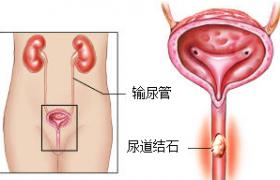 尿道結石 N21.101 尿路結石 泌尿系結石 石淋