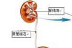 尿道結石 N21.101 尿路結石 泌尿系結石 石淋