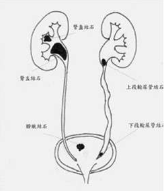 泌尿系結石 泌尿結石 尿石