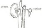 單側腎缺如 單側腎 單側腎未發育 單側腎發育不全 孤立腎
