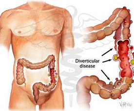 膀胱憩室 N32.301 bladder diverticulum