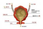 膀胱憩室 N32.301 bladder diverticulum