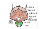 尿路軟斑癥 尿路軟化斑