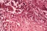 膀胱腺癌 膀胱膠樣癌 膀胱印戒細胞癌 膀胱黏液腺癌