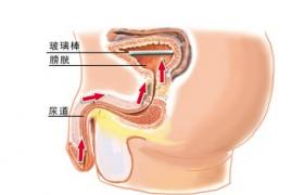 尿道結核