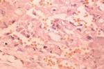 膀胱嗜鉻細胞瘤