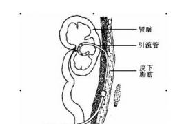 膀胱外翻 Q64.151 