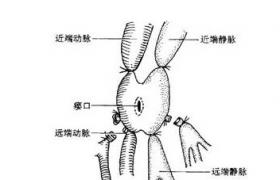 腎動靜脈瘺 腎動脈靜脈瘺