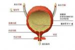 先天性膀胱頸攣縮 膀胱頸攣縮 先天性膀胱頸部梗阻 先天性膀胱