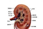 腎皮質髓質膿腫 Renal cortex medulla abscess