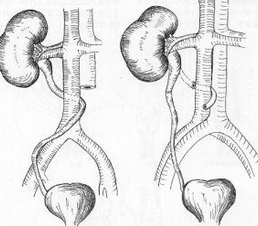 下腔靜脈後輸尿管 環繞腔靜脈輸尿管