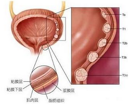 泄殖腔外翻 膀胱腸裂