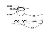 泄殖腔外翻 膀胱腸裂