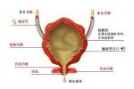 先天性前尿道瓣膜 前尿道瓣膜