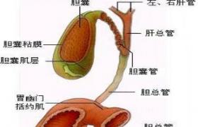 膽結石 膽囊結石