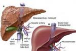 肝血管瘤 hemangiomas
