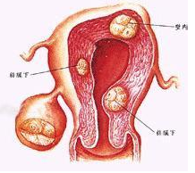 胰腺異位 Q45.301 副胰 迷走胰 迷走胰腺 異位胰腺 副胰腺