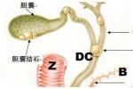 肝外膽管結石