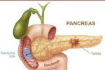 胰腺瘤 M81550 3 胰腺良性腫瘤