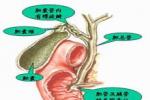 膽囊管綜合征 膽囊管部分阻塞綜合